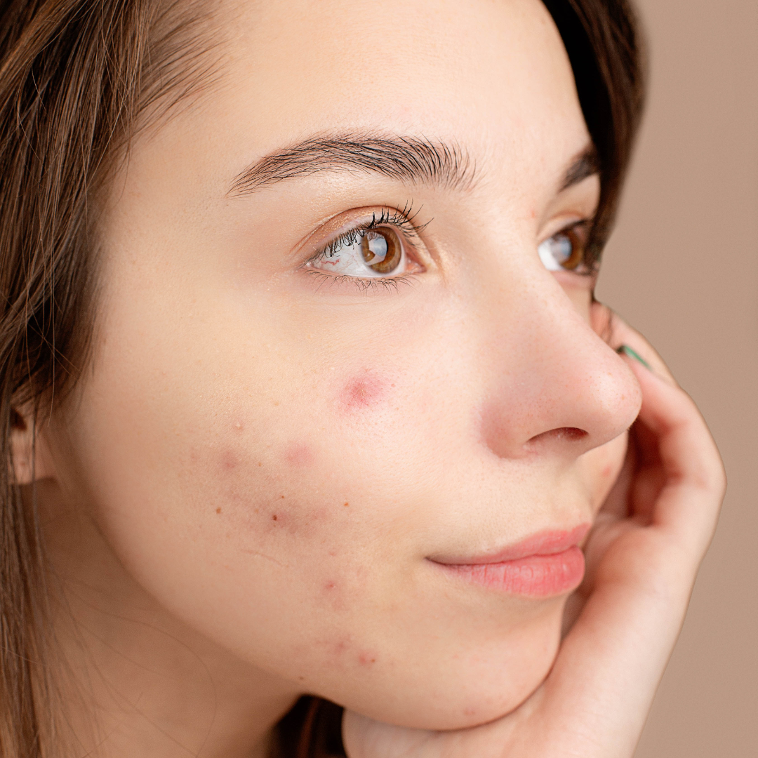 Oily / Acne-Prone Skin